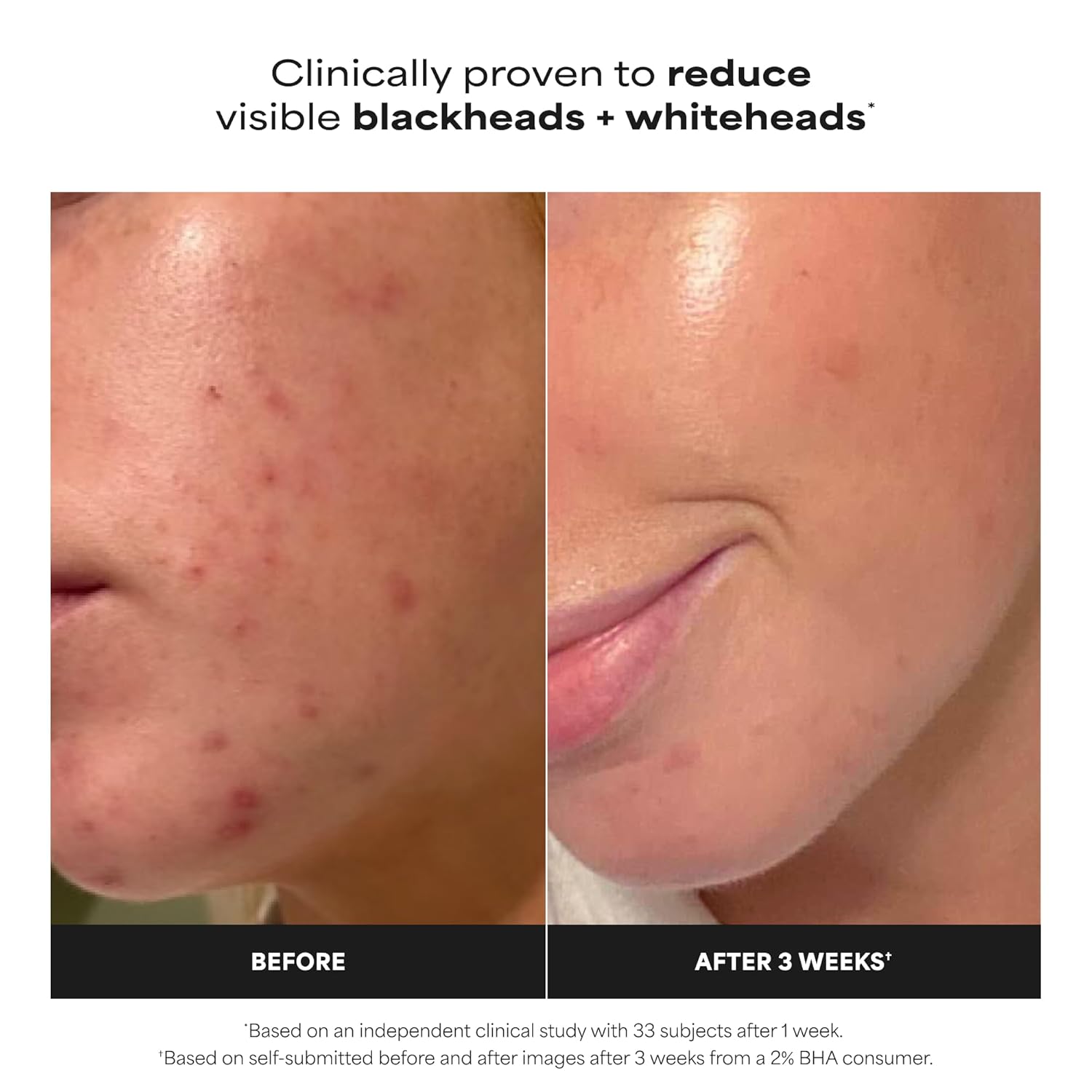 Paula's Choice SKIN PERFECTING 2% BHA Liquid Exfoliant with Salicylic Acid, Facial Polish for Pores, Wrinkles & Fine Lines, Suitable for Blackhead-Prone Skin, Fragrance-Free (Copy) (Copy)