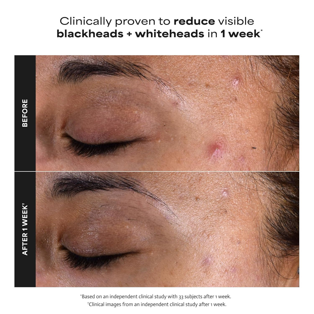 Paula's Choice SKIN PERFECTING 2% BHA Liquid Exfoliant with Salicylic Acid, Facial Polish for Pores, Wrinkles & Fine Lines, Suitable for Blackhead-Prone Skin, Fragrance-Free (Copy) (Copy)